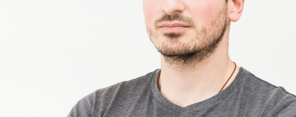 patchy beard example
